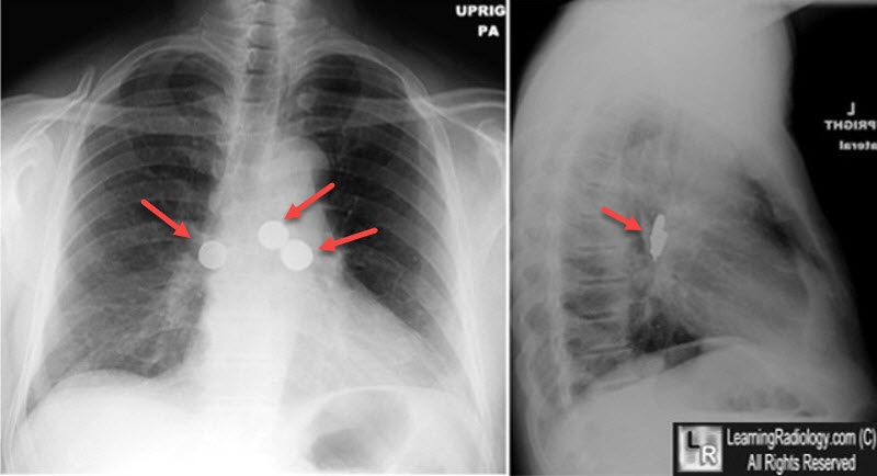 Aspirated Foreign Bodies (Coins)